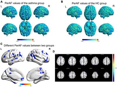 Investigation of altered spontaneous brain activity in patients with bronchial asthma using the percent amplitude of fluctuation method: a resting-state functional MRI study